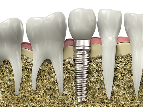 trồng răng implant