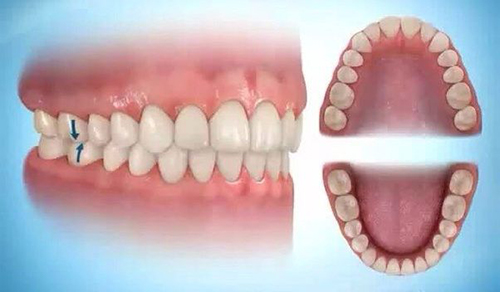 Ảnh hưởng của răng sai khớp cắn