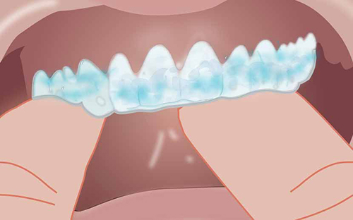 Take-home whitening procedure with Opalescence