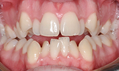 orthodontic treatment - 2