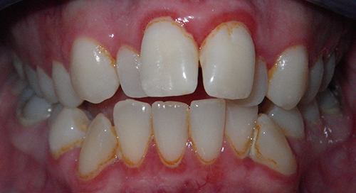 Ảnh hưởng của răng sai khớp cắn