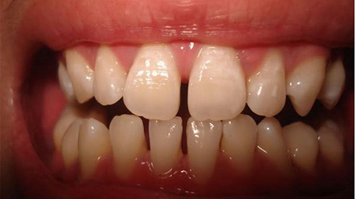 orthodontic treatment - 1