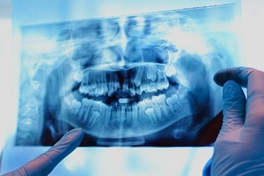 Dental Implantation HCMC